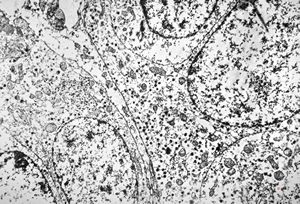 F,44y. | carcinoid - lung F,44y. | carcinoid - lung